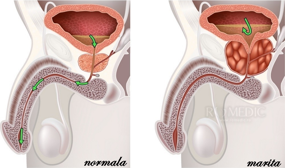 Adenomul de prostată: cauze, simptome, tratament | sincanoua.ro